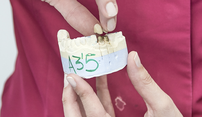 Corona dental Clínica Dental Javier Vaquero - Plasencia